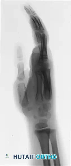 CONGENITAL RING SYNDROME Surgical Diagram