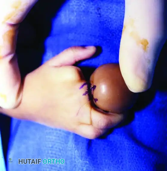 CONGENITAL RING SYNDROME Surgical Diagram