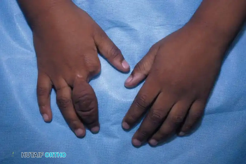 CONGENITAL RING SYNDROME Surgical Diagram