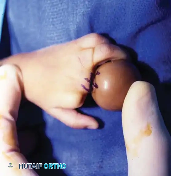 CONGENITAL RING SYNDROME Surgical Diagram