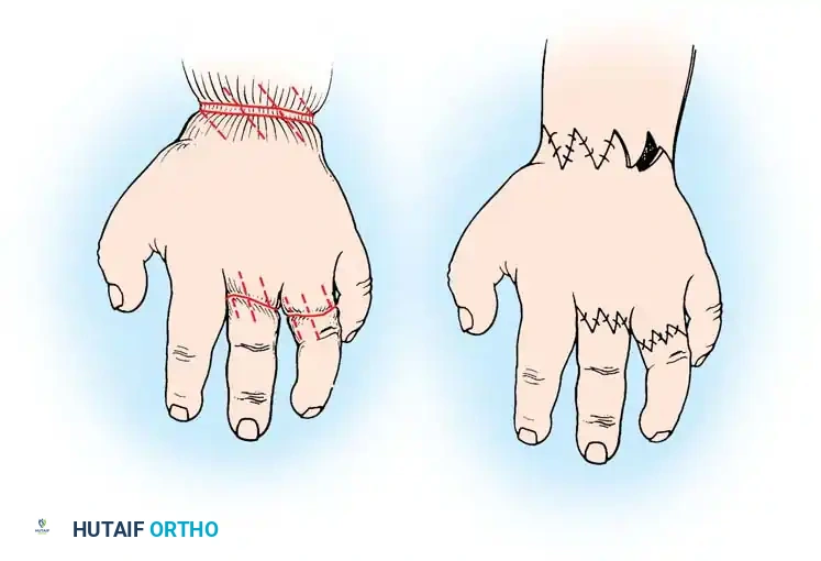 CONGENITAL RING SYNDROME Surgical Diagram