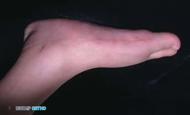 CONGENITAL VERTICAL TALUS Surgical Diagram