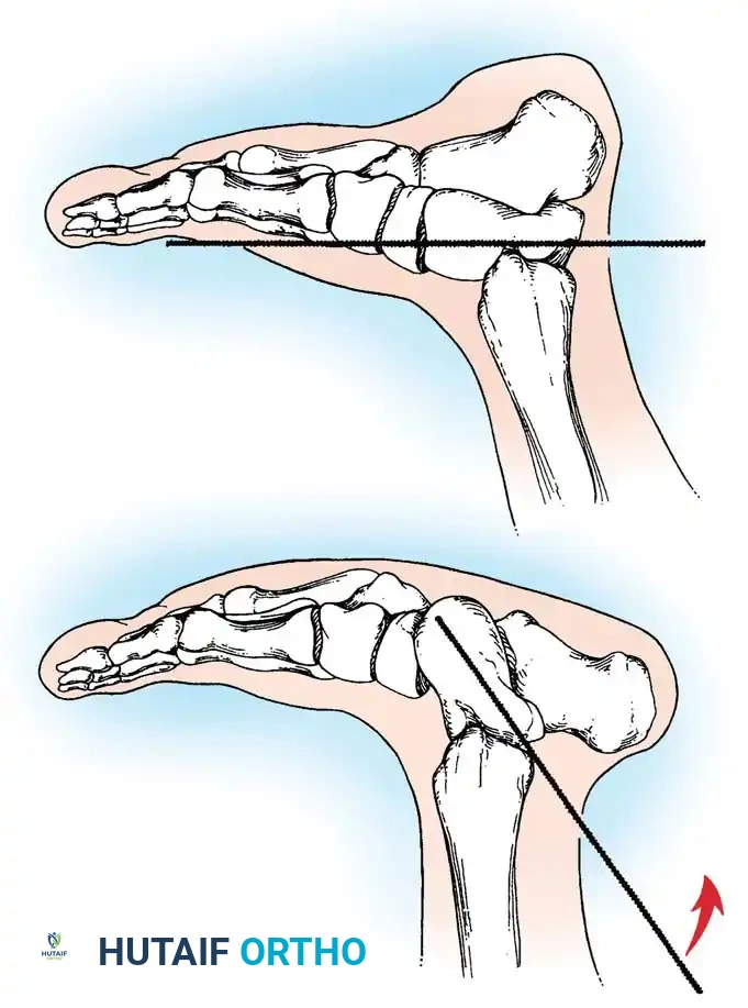 CONGENITAL VERTICAL TALUS Surgical Diagram