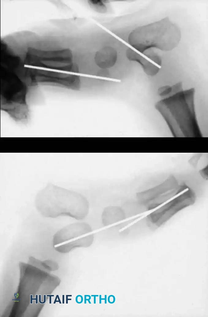 CONGENITAL VERTICAL TALUS Surgical Diagram