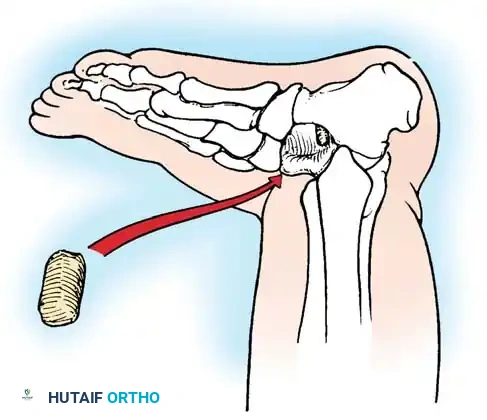 CONGENITAL VERTICAL TALUS Surgical Diagram