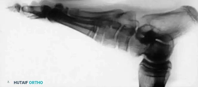 CONGENITAL VERTICAL TALUS Surgical Diagram