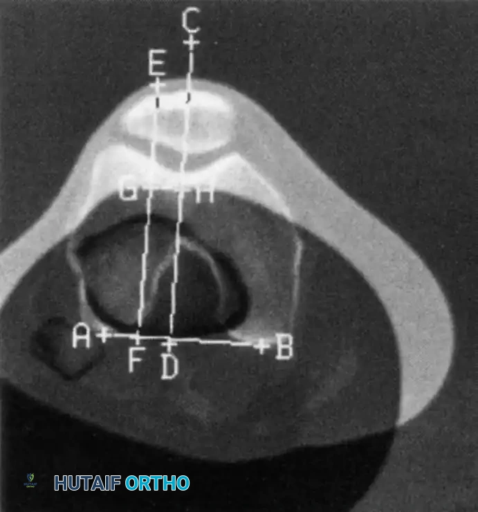 CT determination of tibial tubercle lateralization