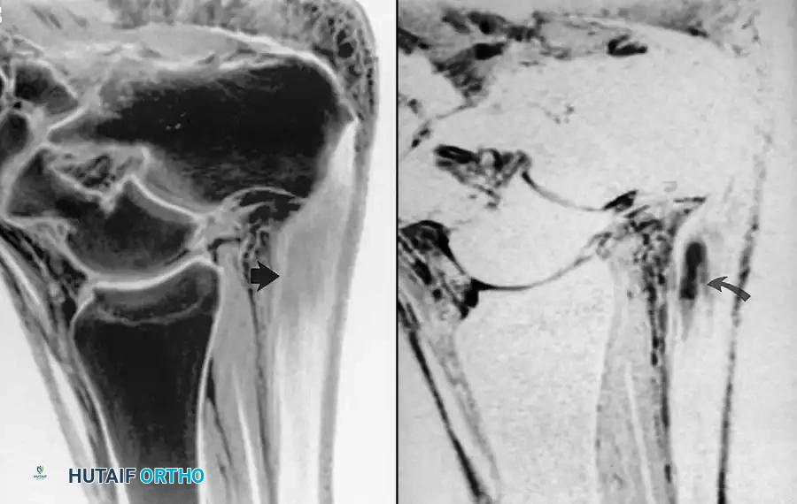 Partial tear of calcaneal tendon