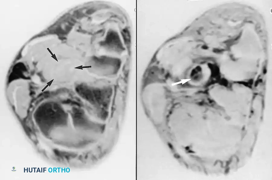 Peroneus longus tendon rupture