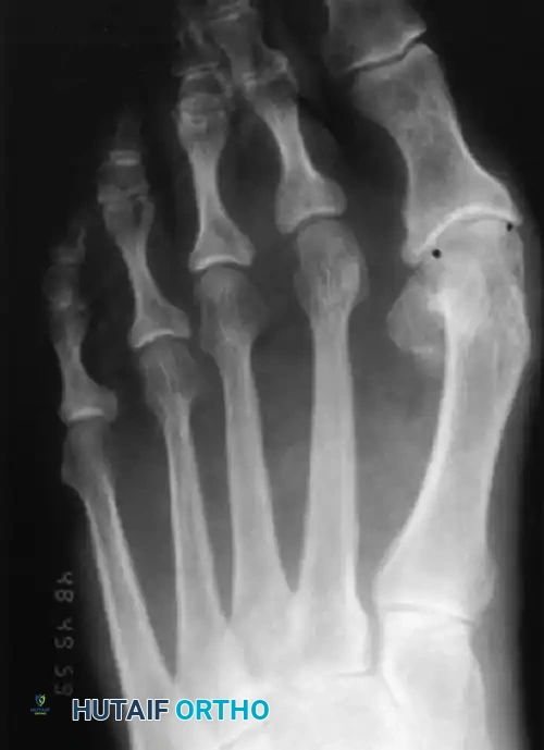 CORRECTING DISTAL METATARSAL OSTEOTOMY Surgical Diagram