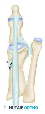 CORRECTION OF DYNAMIC (MULTIPLANAR) HALLUX VARUS Surgical Diagram