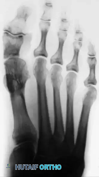 CORRECTION OF DYNAMIC (MULTIPLANAR) HALLUX VARUS Surgical Diagram