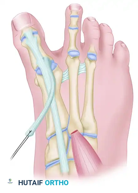 CORRECTION OF DYNAMIC (MULTIPLANAR) HALLUX VARUS Surgical Diagram