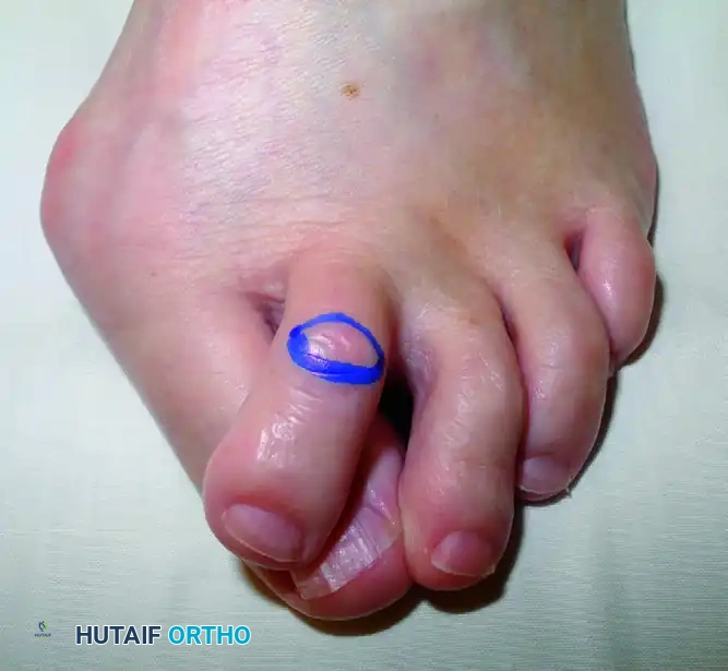 CORRECTION OF FLEXION DEFORMITIES OF THE PROXIMAL INTERPHALANGEAL JOINTS Surgical Diagram