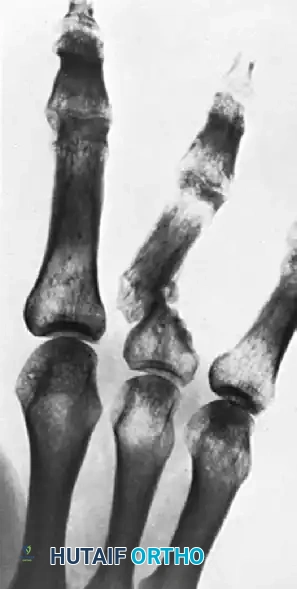 Correction of Metacarpal Neck Malunion: Advanced Surgical Guide