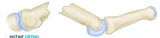 Metacarpal Nonunion Correction: The Littler Bone Grafting Technique