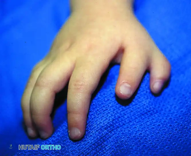 Clinical appearance of triphalangeal thumb associated with duplication