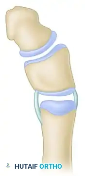 Peimer reduction osteotomy. B, Narrowing of distal phalanx.