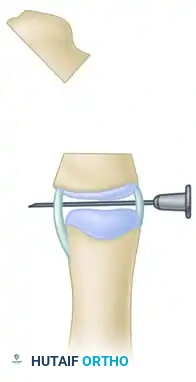 Peimer reduction osteotomy. E, Completion of osteotomy.