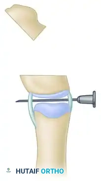 Peimer reduction osteotomy. F, Combined osteotomies form closing wedge.