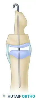 Radiographic appearance of triphalangeal thumb