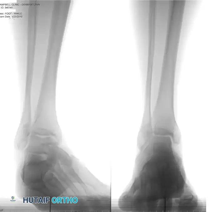 DÉBRIDEMENT OF THE PERONEUS LONGUS TENDON, REMOVAL OF OS PERONEUM, AND TENODESIS OF PERONEUS LONGUS TENDON TO PERONEUS BREVIS TENDON Surgical Diagram