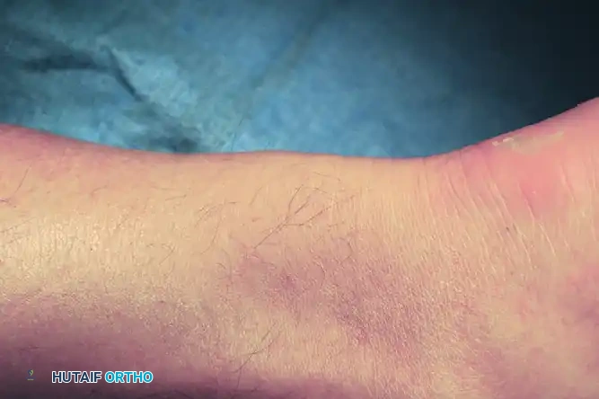 DÉBRIDEMENT OF THE TENDON FOR INSERTIONAL ACHILLES TENDON DISEASE Surgical Diagram