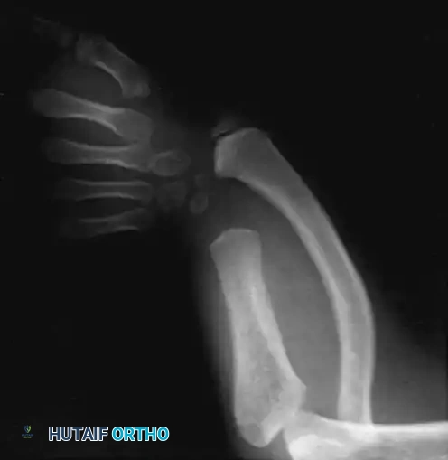 Radiographic appearance of type I ulnar clubhand