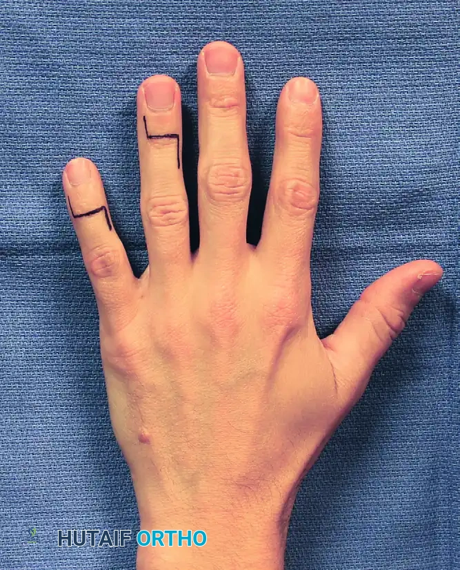 DEFORMITIES OF THE THUMB Surgical Diagram