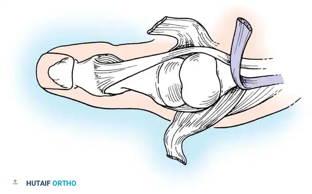 Surgical Management of Rheumatoid and Osteoarthritic Thumb Deformities
