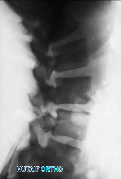 Degenerative Spondylolisthesis and Scoliosis: Comprehensive Surgical Management
