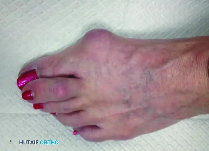 Metatarsophalangeal Joint Synovitis and Instability: Surgical Guide