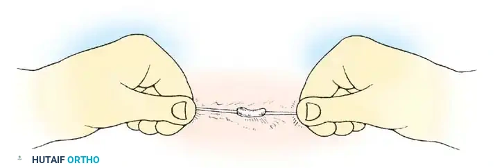 DIFFERENTIATION OF MUSCLE DISEASE FROM NERVE DISEASE Surgical Diagram