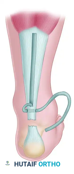 Neglected Achilles Tendon Rupture Repair: Surgical Guide