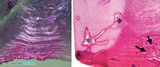 Fig. 39-2 Histological ﬁ ndings of human intervertebral discs. A, Specimen from 2.5-year-old child shows how regular concentric lamellae can be seen when specimen is viewed with polarized light. B, Specimen from neonate, showing how outer aspect of anulus ﬁ brosus and cartilage end plate are vascularized with blood vessels (arrows) and vascular channels (asterisks) . ( A and B stained with hematoxylin and eosin; original magniﬁ cation, × 10 [A] and × 30 [B] .) (From Roberts S, Evans H, Trivedi J, et al: Histology and pathology of the human intervertebral disc, J Bone Joint Surg 88A:10, 2006.)