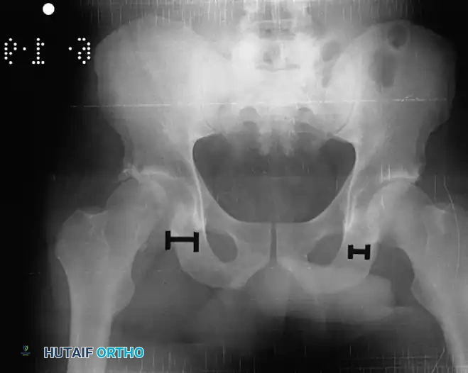 Fig. 52-45 Widening of medial joint space after closed reduction of type I posterior dislocation of hip suggests retained osteocartilaginous fragments within joint.
