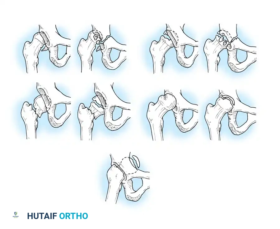 DISLOCATION AND FRACTUREDISLOCATION OF THE HIP Surgical Diagram