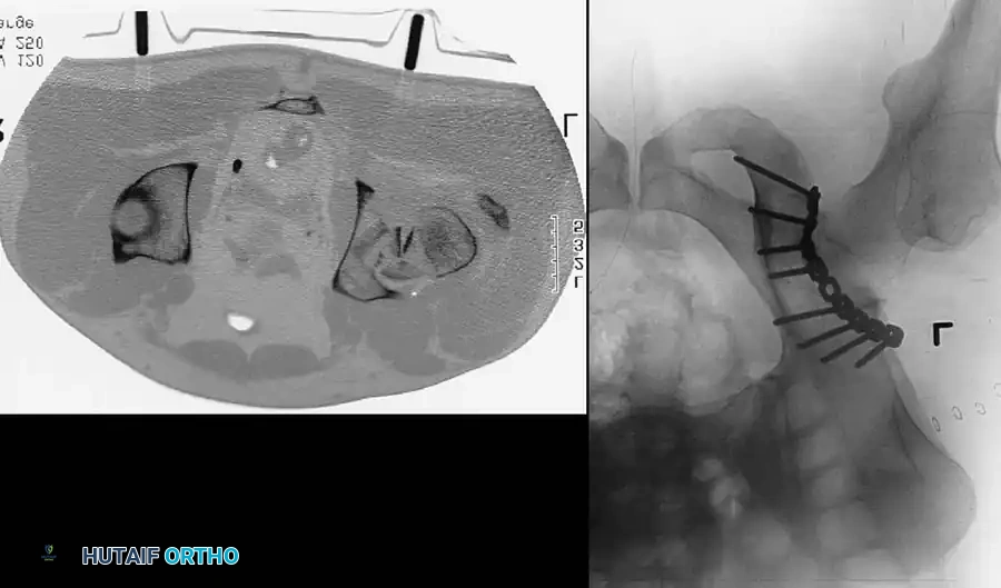 DISLOCATION AND FRACTUREDISLOCATION OF THE HIP Surgical Diagram