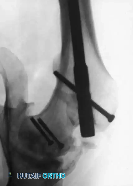 DISLOCATION AND FRACTUREDISLOCATION OF THE HIP Surgical Diagram