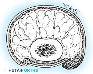 Fig. 84-1 A, Anatomy of normal toenail (see text). B, Ingrown toenail (see text). C, Cross section of ingrown toenail (see text). D, Nail is lifted with cotton.