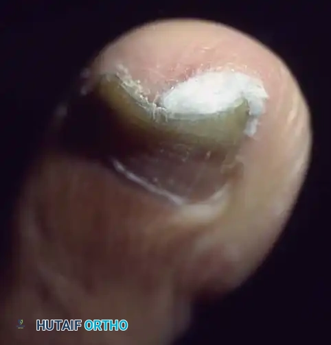 Fig. 84-1 A, Anatomy of normal toenail (see text). B, Ingrown toenail (see text). C, Cross section of ingrown toenail (see text). D, Nail is lifted with cotton.