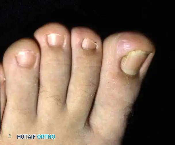 Fig. 84-4 A and B, Turned up pulp deformity after multiple nail avulsions for treatment of ingrown toenail. C, Turned up deformity after several nail avulsions.