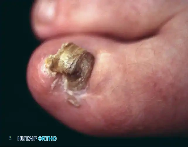 Fig. 84-6 Deformity of nail bed after laceration of nail matrix.