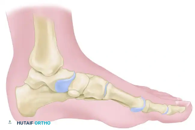 Kidner Procedure Incision