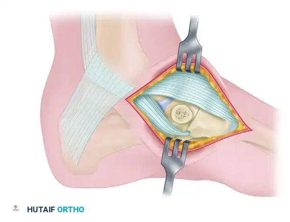 Final Flush Alignment