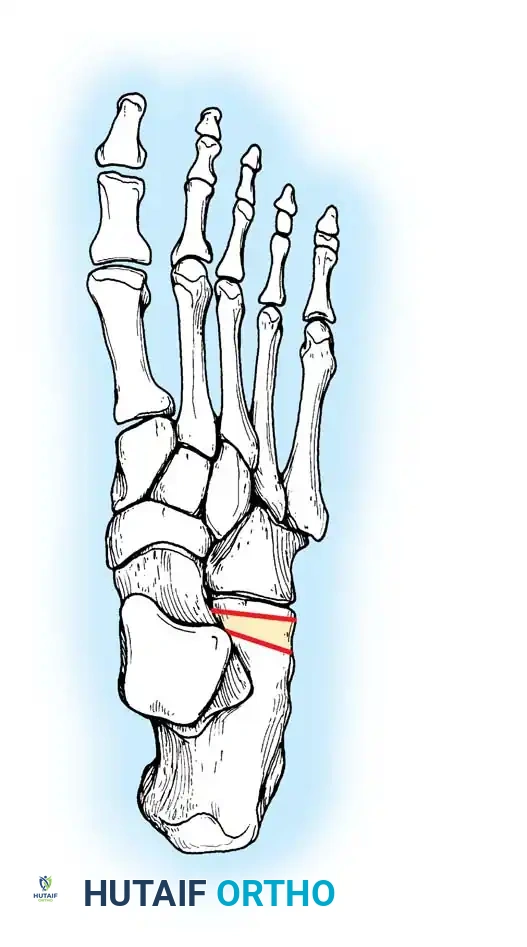 تعديل عظام القدم لعلاج مضاعفات تسطح القدم
