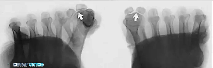 Fig. 78-5 A, Plantar surface of ﬁ rst metatarsal head. Entire sesamoid sling with attached intrinsic musculature has been rotated distally off metatarsal head to present schematically relationships of muscle, tendon, capsule, ligaments, and articular conﬁ guration of ﬁ rst metatarsophalangeal joint. B, As metatarsal head moves medially, sesamoid sling apparatus becomes valgus deforming force, and metatarsal rotates (pronates) on its longitudinal axis. Intrinsic and extrinsic muscle balance is lost, and deformity increases. ( A after Beverly Kessler; courtesy of LTI Medica and The Upjohn Company.)