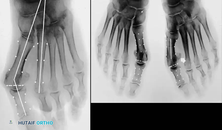 Disorders of the Hallux Surgical Diagram