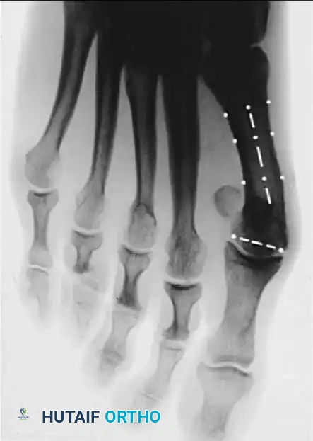 Disorders of the Hallux Surgical Diagram