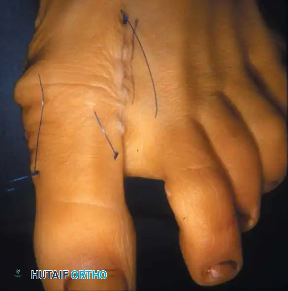 Fig. 78-12 Hallux valgus treated by modiﬁ ed McBride procedure. A, Preoperative deformity in 30-year-old patient. B, Correction obtained at surgery. C, Preoperative and postoperative radiographs (note ﬁ bular sesamoid was not removed). More deformity can be corrected by ﬁ bular sesamoidectomy, but overcorrection (hallux varus) is risk. If ﬁ bular sesamoid is excised, medial capsule should be closed while holding hallux in 5 to 10 degrees valgus and kept in that position until capsular healing.